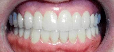 After — Smile transformation 4