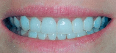 After — Smile transformation 6