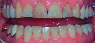 Before — Smile transformation 1
