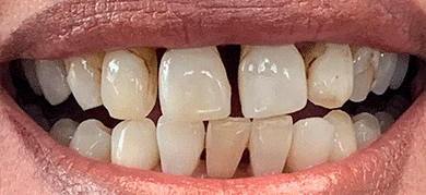 Before — Smile transformation 2