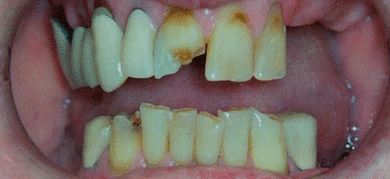 Before — Smile transformation 3