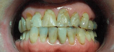 Before — Smile transformation 4