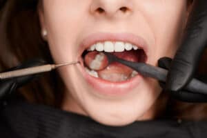Ask Your Boise Dentist: Where Are All Of These Cavities Coming From?
