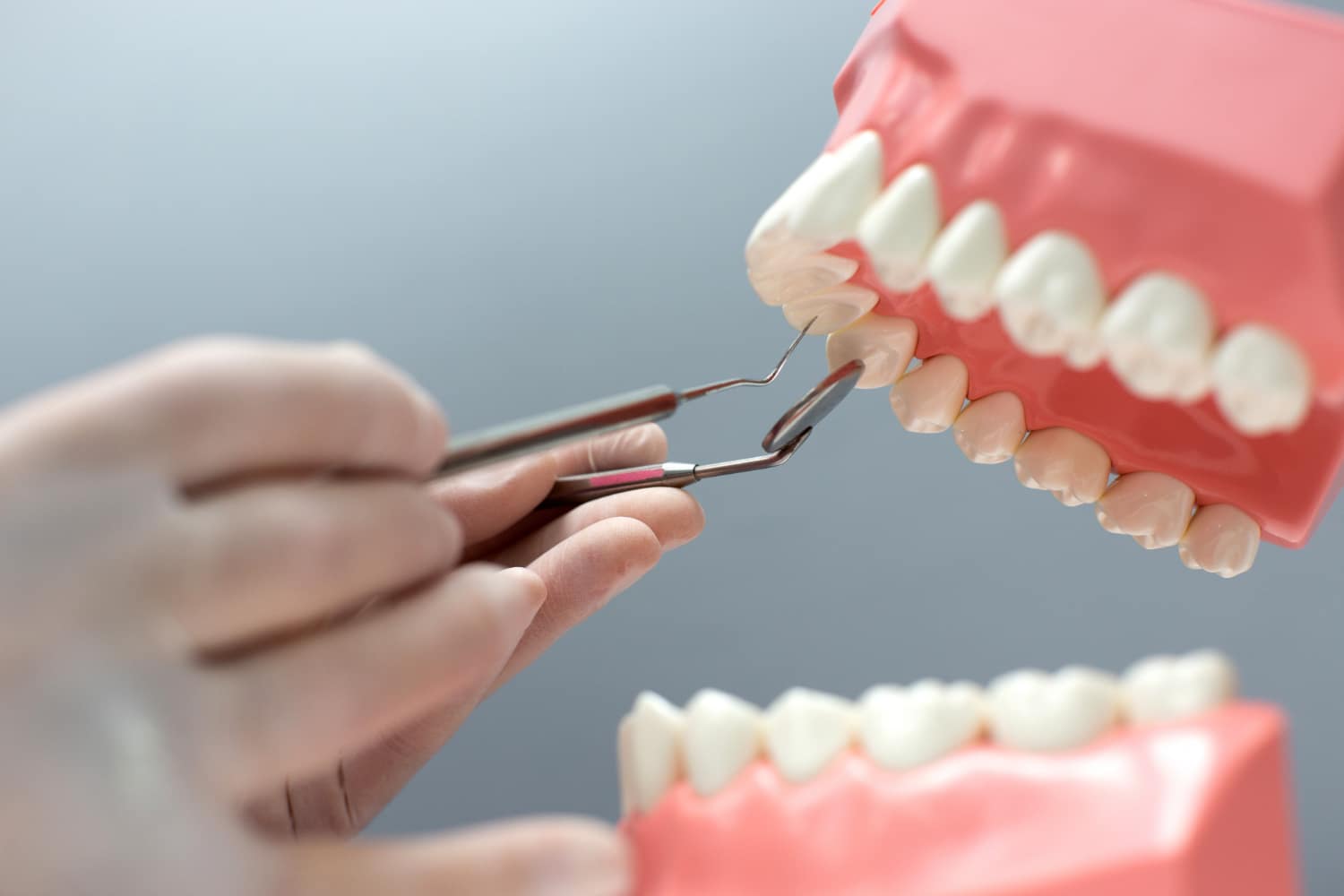 Dental Implants vs. Dental Bridges